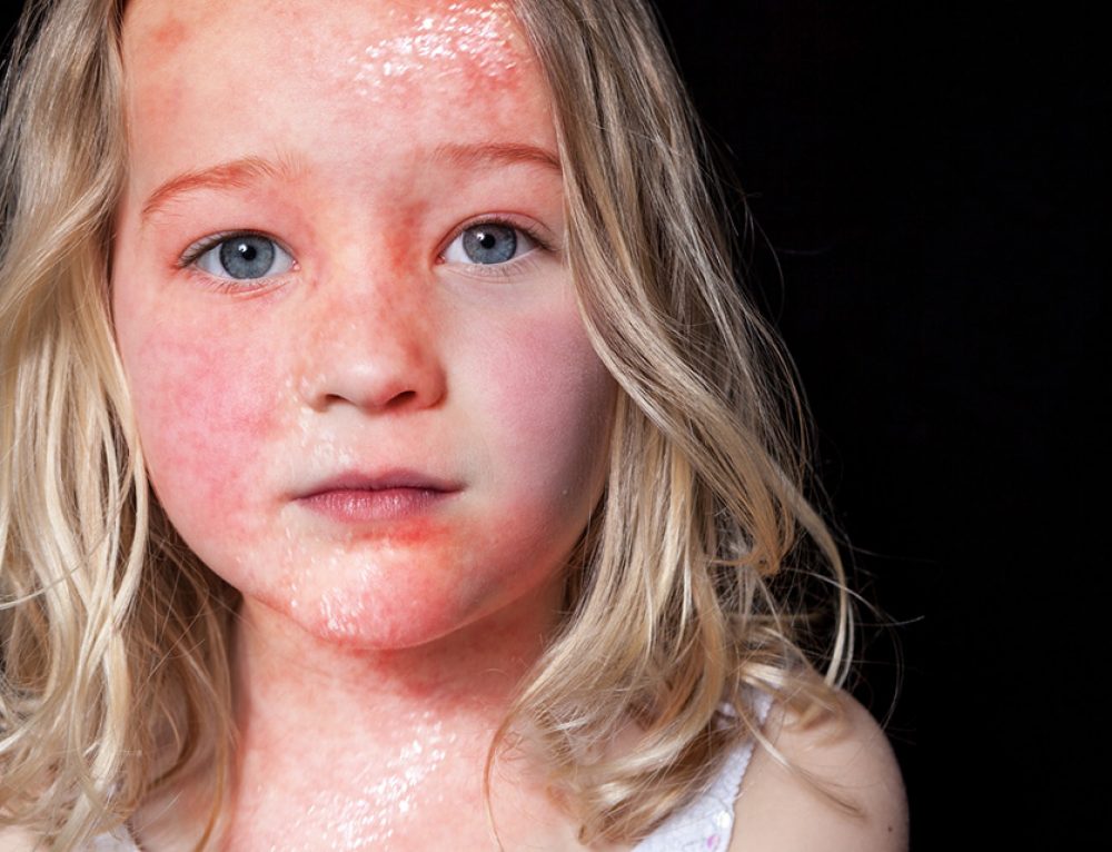 Topical Steroid Addiction TSA Psoriasis Seborrheic Dermatitis And 
