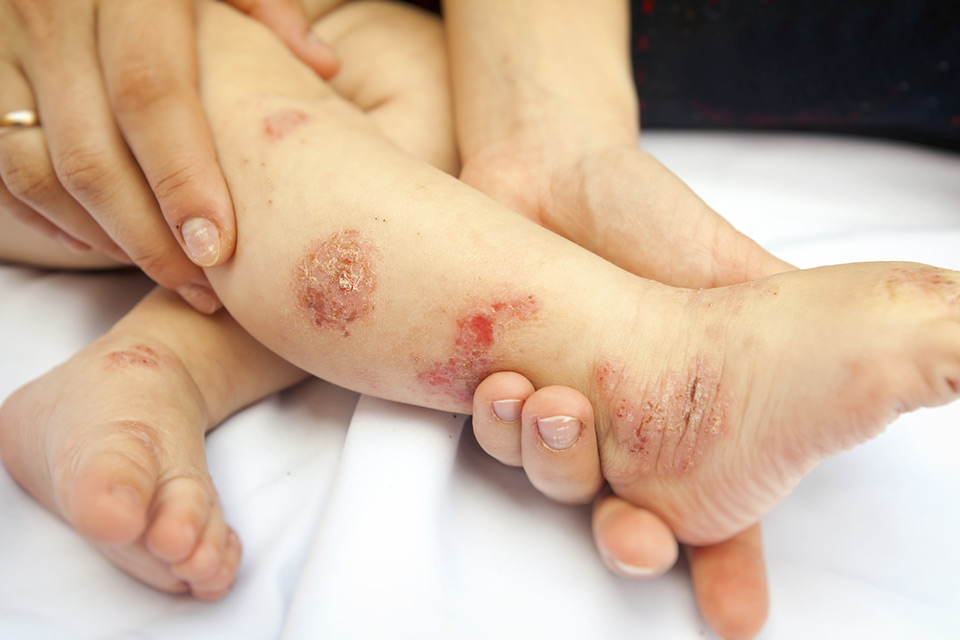 Easy Steps To steroids for poison ivy Of Your Dreams